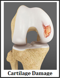 Cartilage Transplantation