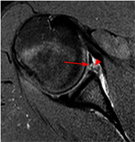 MRI Arthrogram