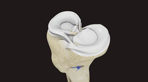 Arthroscopic Meniscus Repair