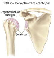 Total Shoulder Replacement